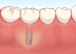 implant_img15